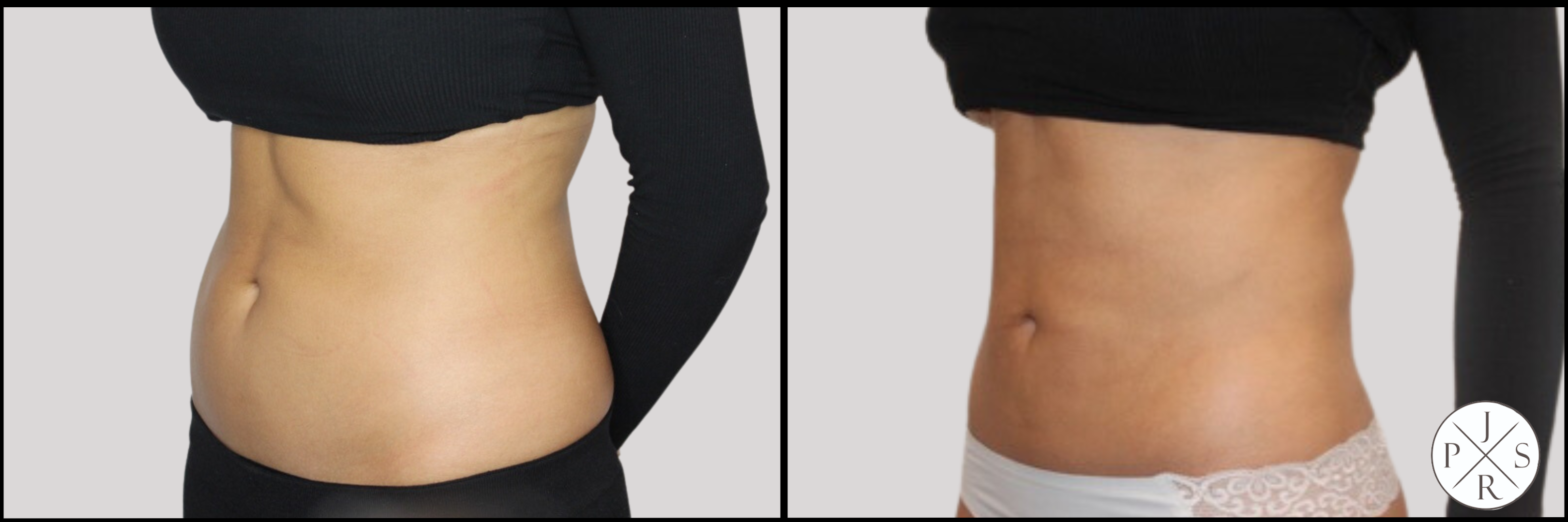 Liposuction Before & After Image